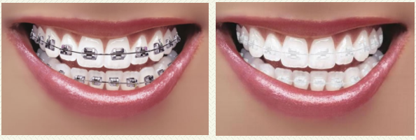 teeth straightening